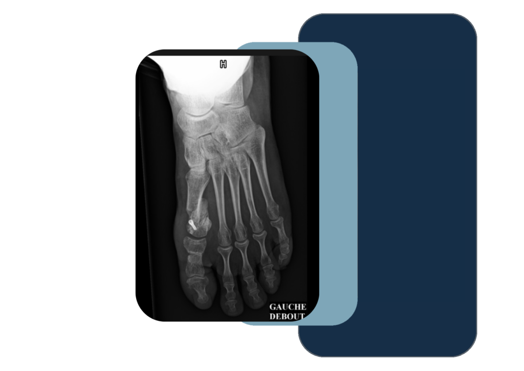 hallux valgus opéré